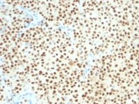 FFPE human melanoma sections stained with 100 ul anti-SOX10 (clone SOX10/1074) at 1:50. HIER epitope retrieval prior to staining was performed in 10mM Citrate, pH 6.0.